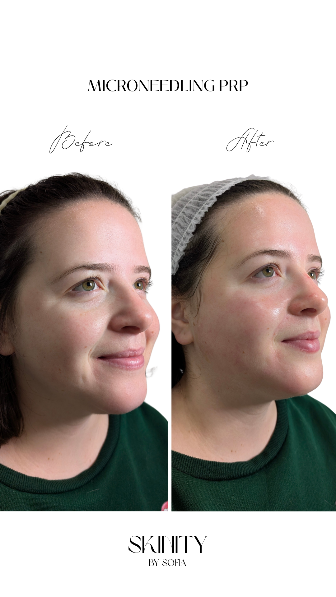 Microneedling PRP Results