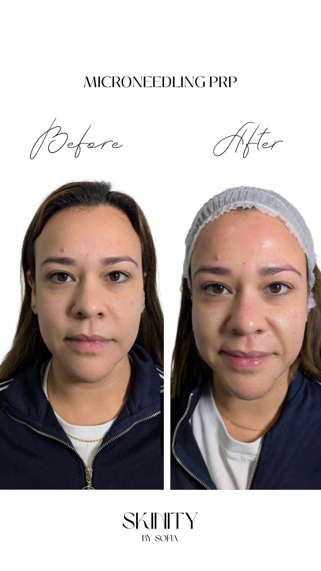 Microneedling PRP Results